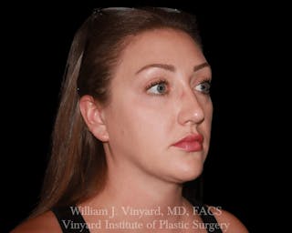 Facetite Before & After Gallery - Patient 169742916 - Image 4