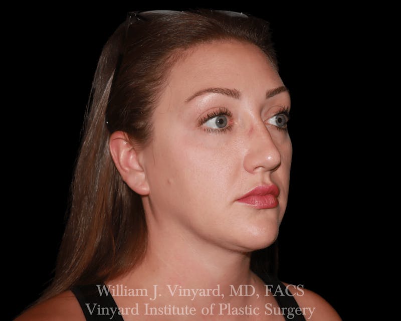 Facetite Before & After Gallery - Patient 169742916 - Image 4