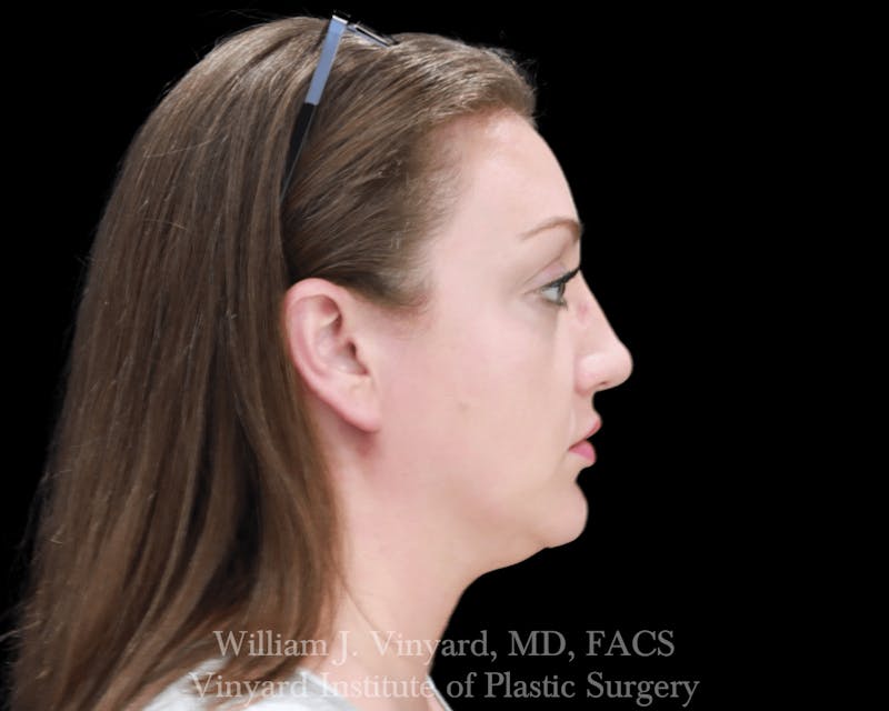 Facetite Before & After Gallery - Patient 169742916 - Image 5