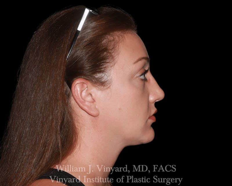 Facetite Before & After Gallery - Patient 169742916 - Image 6