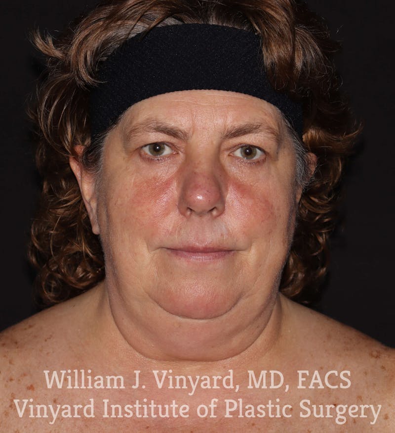 Facetite Before & After Gallery - Patient 169742929 - Image 3