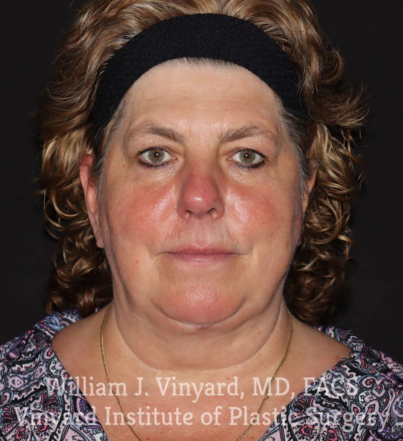 Facetite Before & After Gallery - Patient 169742929 - Image 4