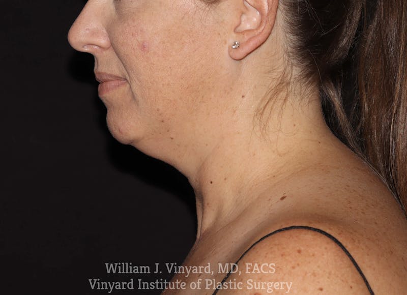 Facetite Before & After Gallery - Patient 169742932 - Image 1