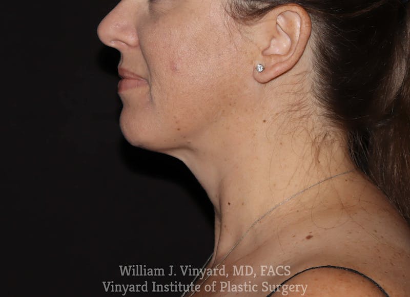 Facetite Before & After Gallery - Patient 169742932 - Image 2