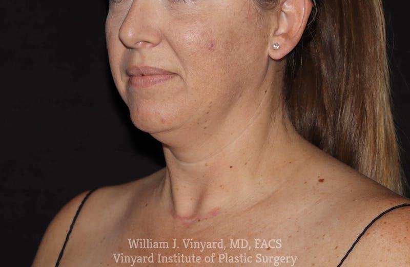 Facetite Before & After Gallery - Patient 169742932 - Image 3