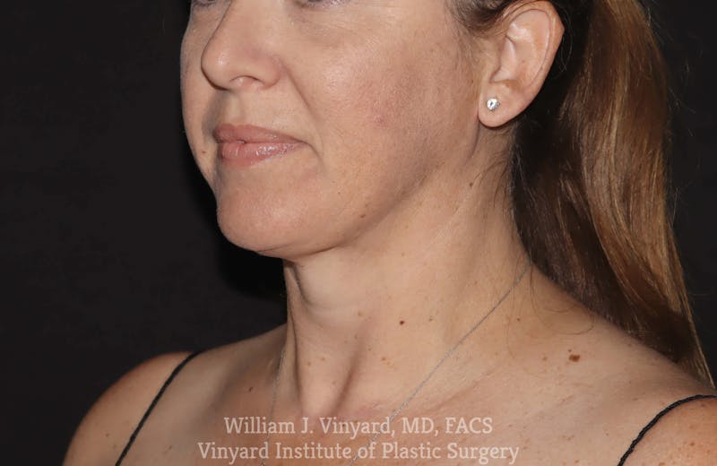 Facetite Before & After Gallery - Patient 169742932 - Image 4