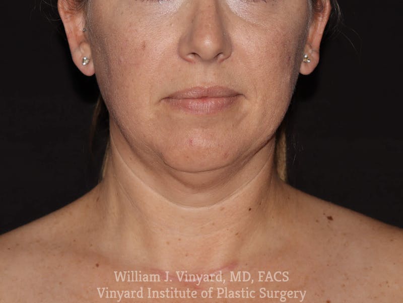 Facetite Before & After Gallery - Patient 169742932 - Image 5