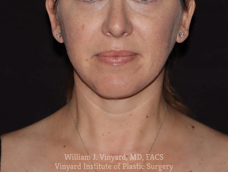 Facetite Before & After Gallery - Patient 169742932 - Image 6