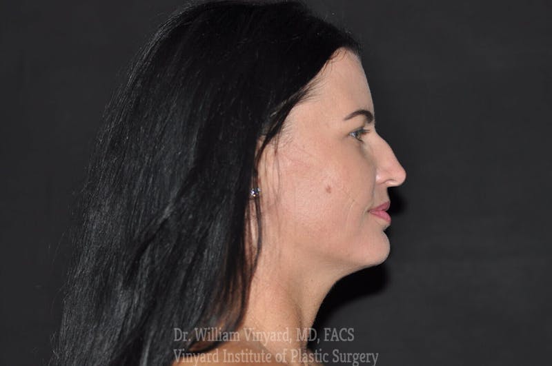 Facetite Before & After Gallery - Patient 169742939 - Image 3