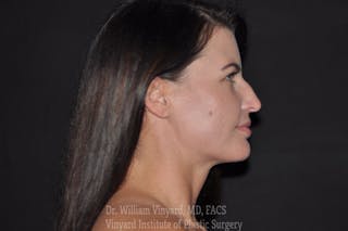 Facetite Before & After Gallery - Patient 169742939 - Image 4