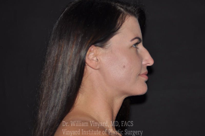 Facetite Before & After Gallery - Patient 169742939 - Image 4