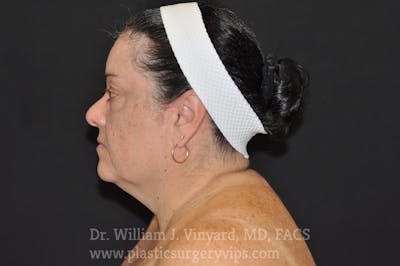Facetite Before & After Gallery - Patient 169742941 - Image 1