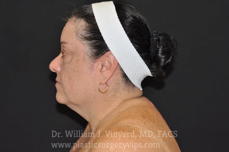 Facetite Before & After Gallery - Patient 169742941 - Image 1