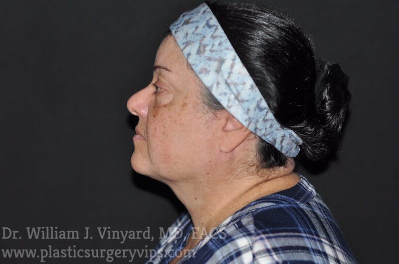 Facetite Before & After Gallery - Patient 169742941 - Image 2