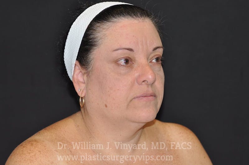 Facetite Before & After Gallery - Patient 169742941 - Image 3