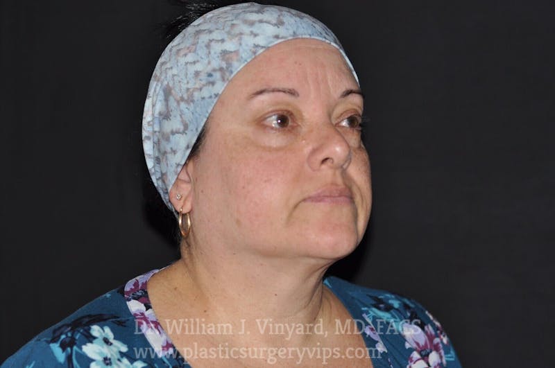 Facetite Before & After Gallery - Patient 169742941 - Image 4