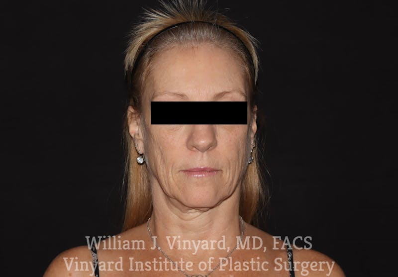 Facelift Before & After Gallery - Patient 169743448 - Image 1