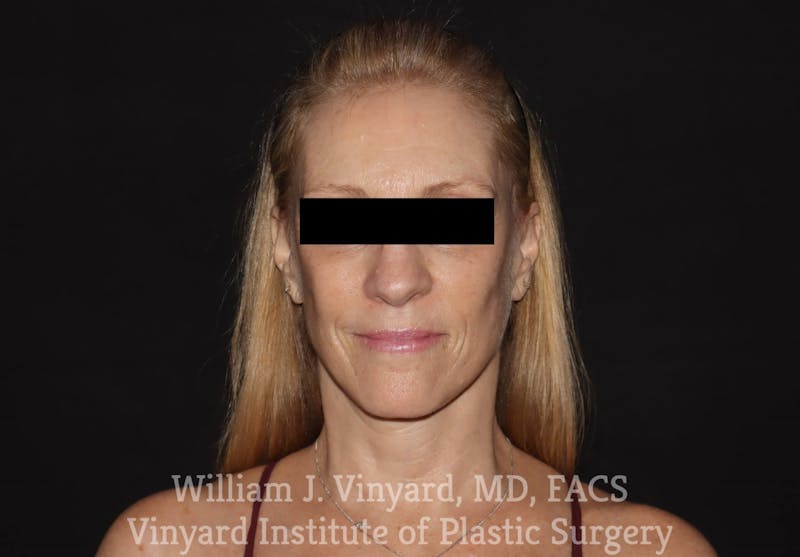 Facelift Before & After Gallery - Patient 169743448 - Image 2