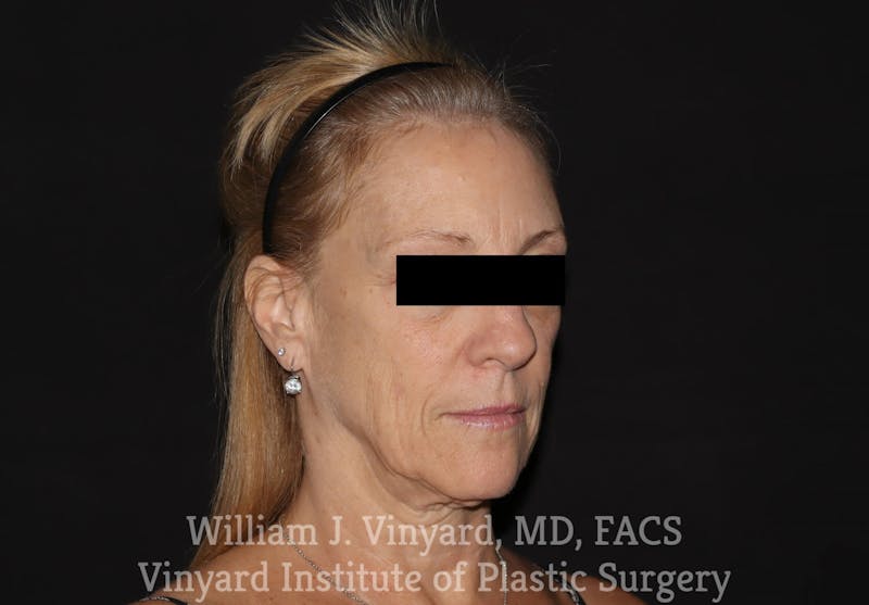 Facelift Before & After Gallery - Patient 169743448 - Image 3