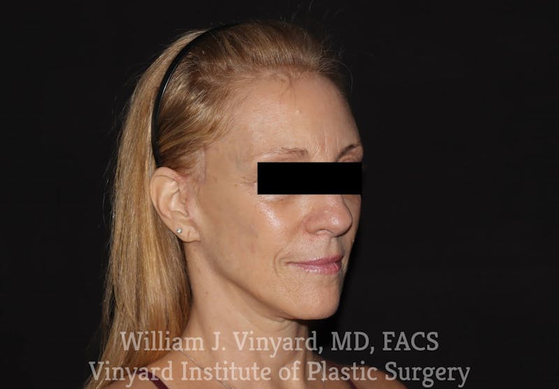 Facelift Before & After Gallery - Patient 169743448 - Image 4