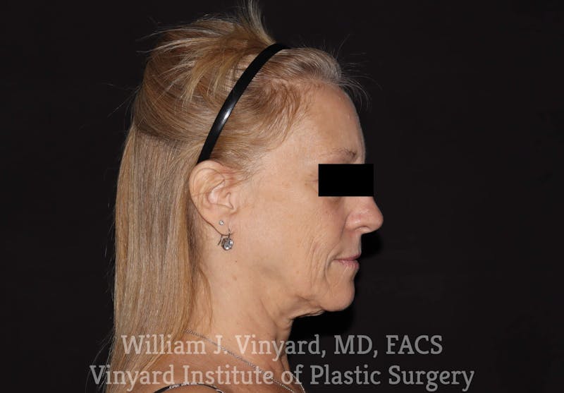 Facelift Before & After Gallery - Patient 169743448 - Image 5