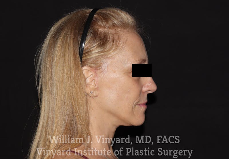 Facelift Before & After Gallery - Patient 169743448 - Image 6