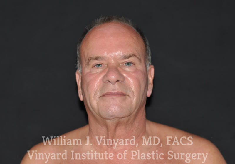 Facelift Before & After Gallery - Patient 169743449 - Image 1
