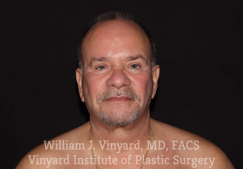 Facelift Before & After Gallery - Patient 169743449 - Image 2