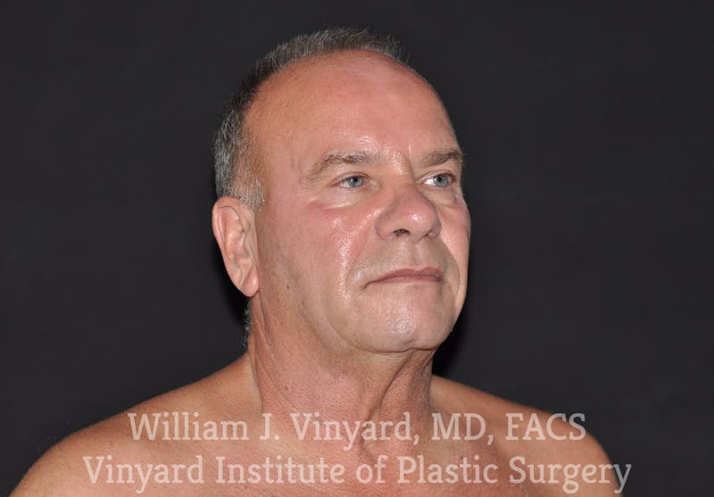 Facelift Before & After Gallery - Patient 169743449 - Image 3