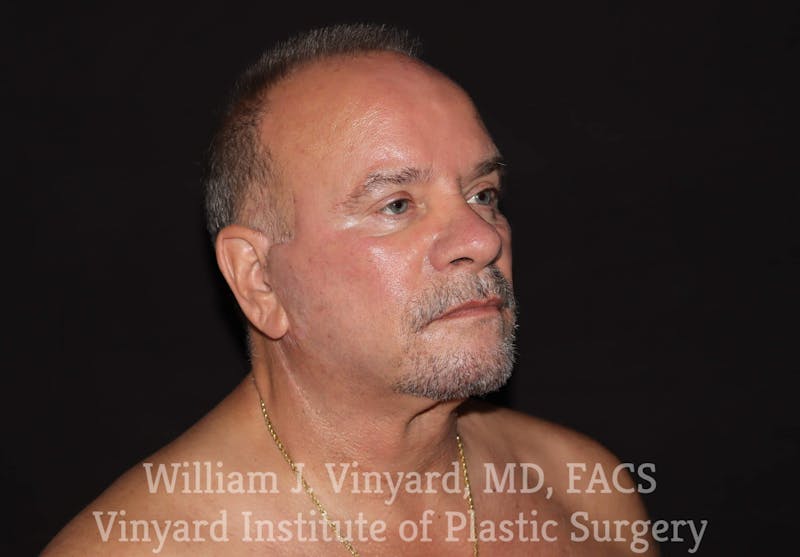 Facelift Before & After Gallery - Patient 169743449 - Image 4