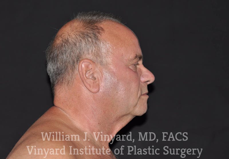 Facelift Before & After Gallery - Patient 169743449 - Image 5