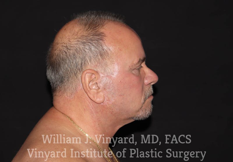 Facelift Before & After Gallery - Patient 169743449 - Image 6