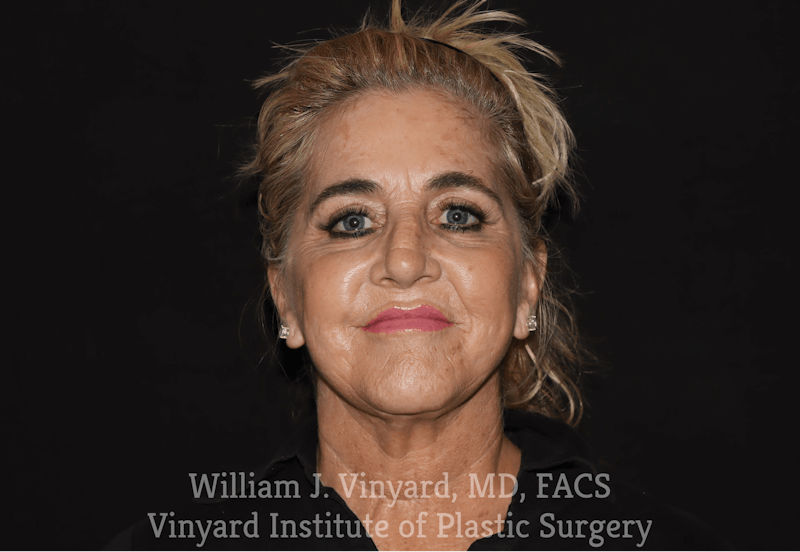 Facelift Before & After Gallery - Patient 169743450 - Image 2