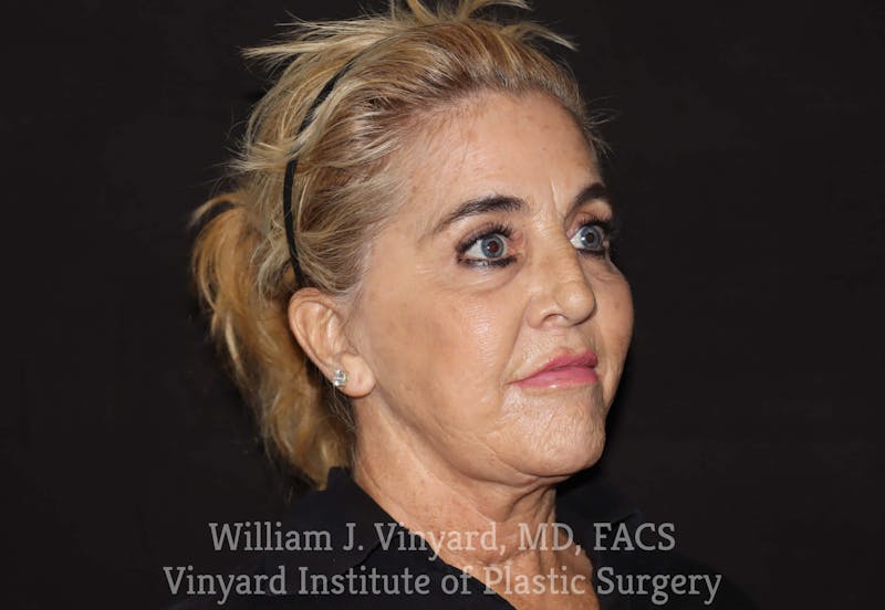 Facelift Before & After Gallery - Patient 169743450 - Image 4