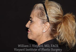Facelift Before & After Gallery - Patient 169743450 - Image 6