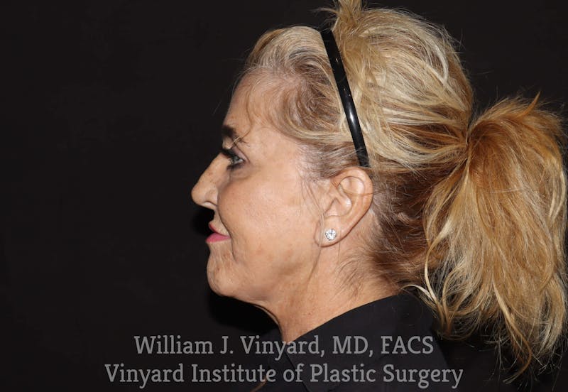 Facelift Before & After Gallery - Patient 169743450 - Image 6