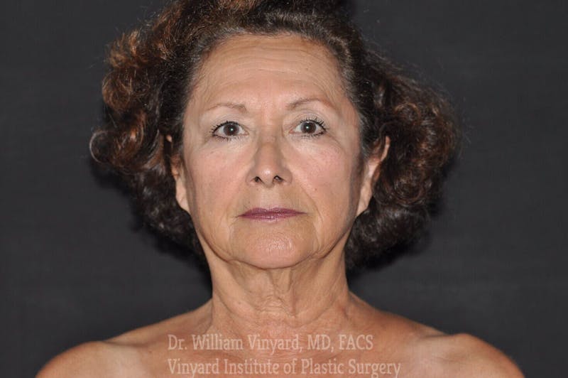 Facelift Before & After Gallery - Patient 169743453 - Image 1