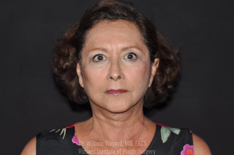 Facelift Before & After Gallery - Patient 169743453 - Image 2