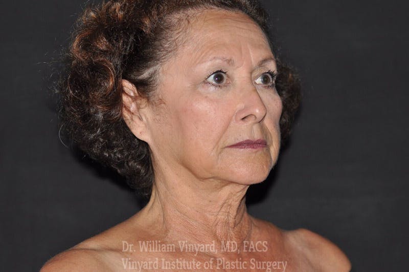 Facelift Before & After Gallery - Patient 169743453 - Image 3