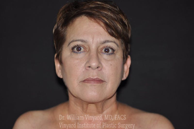 Facelift Before & After Gallery - Patient 169743454 - Image 1