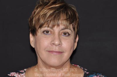 Facelift (Cheek and Neck Lift) Before & After Gallery - Patient 169743454 - Image 2