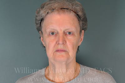 Facelift Before & After Gallery - Patient 169743473 - Image 1