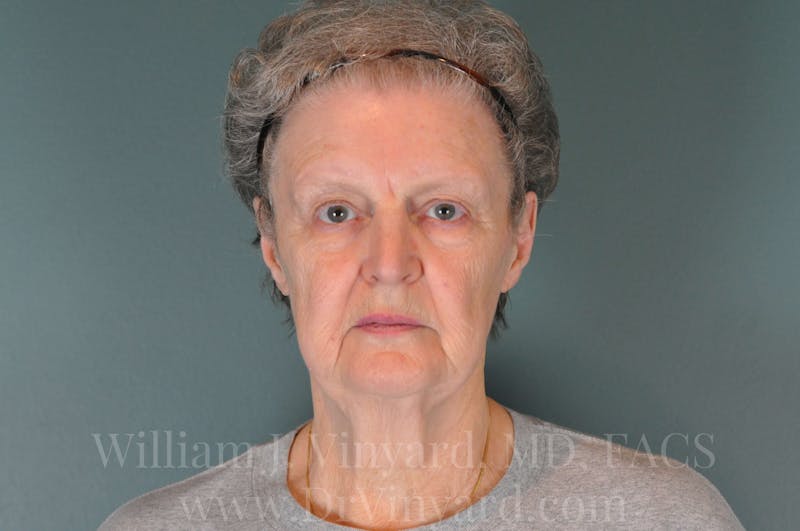 Facelift Before & After Gallery - Patient 169743473 - Image 1