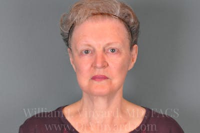 Facelift (Cheek and Neck Lift) Before & After Gallery - Patient 169743473 - Image 2