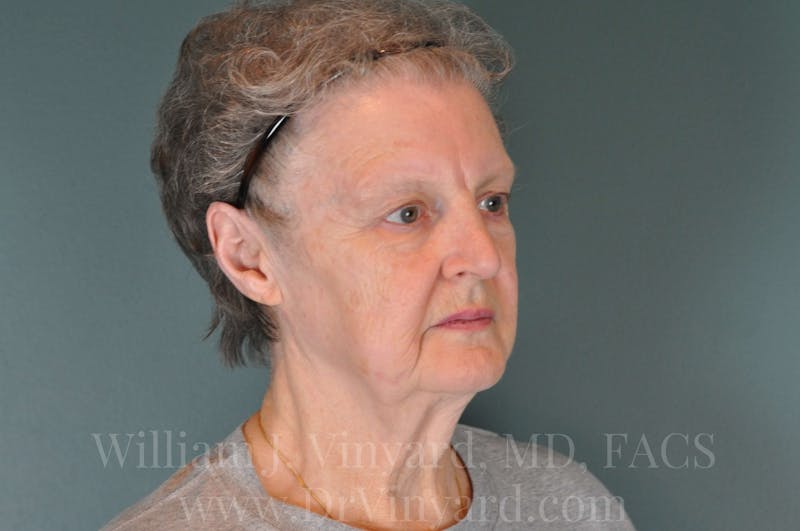 Facelift Before & After Gallery - Patient 169743473 - Image 3