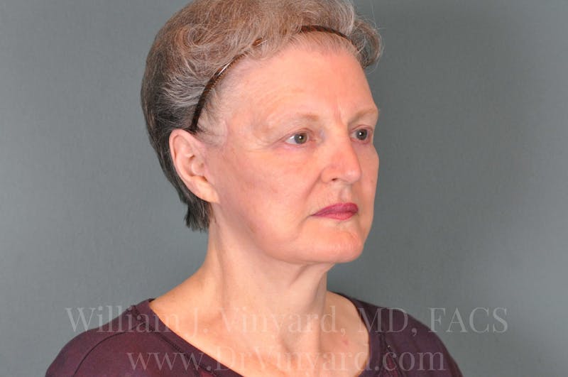 Facelift Before & After Gallery - Patient 169743473 - Image 4