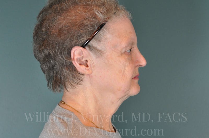 Facelift Before & After Gallery - Patient 169743473 - Image 5