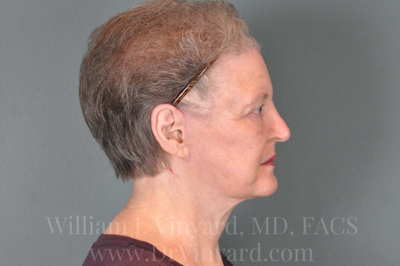 Facelift Before & After Gallery - Patient 169743473 - Image 6