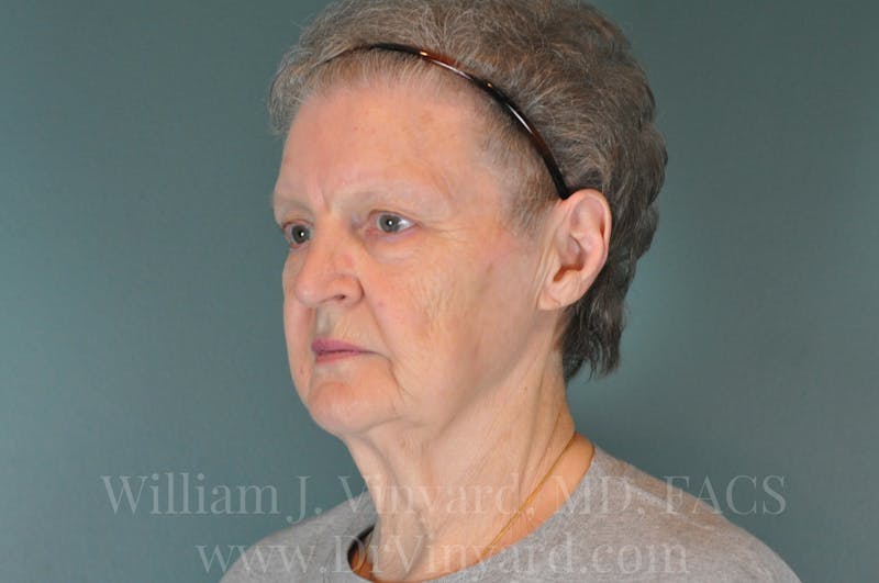 Facelift Before & After Gallery - Patient 169743473 - Image 7