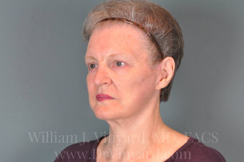 Facelift Before & After Gallery - Patient 169743473 - Image 8